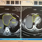 tumor tumor